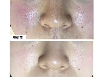 スリリアン 銀座/★ニキビ劇的ビフォーアフター★