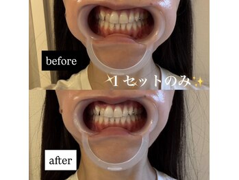 スールボーテ(soeur beaute)の写真/《笑顔を引き立てる白い歯へ♪》第一印象を左右する歯のケア始めませんか？食事制限なし！本来の白さへ★