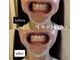 スールボーテ(soeur beaute)の写真/《笑顔を引き立てる白い歯へ♪》第一印象を左右する歯のケア始めませんか？食事制限なし！本来の白さへ★