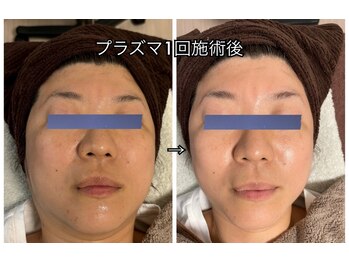 リアナ(Lien_A)/プラズマフェイシャル1回施術後