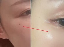 コウベ美容鍼灸治療院(KOBE美容鍼灸治療院)の雰囲気（☆シミケア×美白(1回)表層のシミへアプローチしお肌も明るく！）