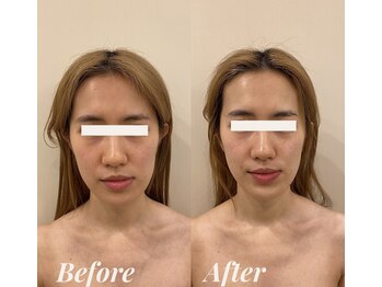 シェリール(Cherir)/小顔矯正