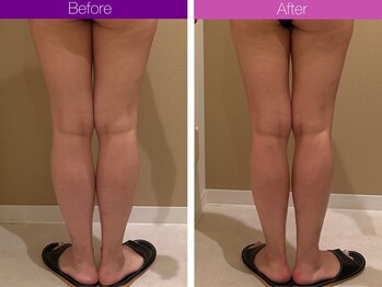 クレヴィア バイ サイバーエステ(CREBIA)/太ももに隙間を!