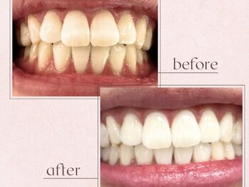 ルアナシンフォニア エクシア 池袋店(Luana-Sinfonia)/ホワイトニングビフォーアフター