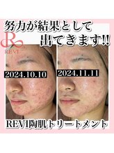 アルムダアクア 天王寺店(Aleumda AQUA)/ハーブピーリング/大阪/天王寺