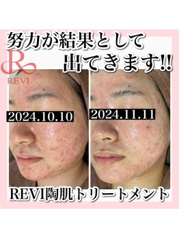 アルムダアクア 天王寺店(Aleumda AQUA)/ハーブピーリング/大阪/天王寺