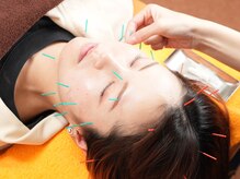 美容鍼も人気です