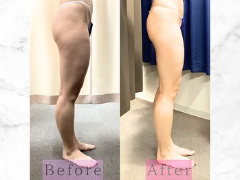 パラディ(PARADIS)/ハイパーナイフ/シェイプ/コルギ