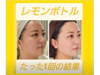 アン 銀座(ann)の写真/二重アゴ撃退！切らずに「レモンボトル」で叶う即効小顔ケア。天然由来◎脂肪分解◎