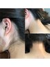 【うなじ脱毛】うなじ美人目指しませんか♪[尾道/脱毛/うなじ脱毛/部分脱毛]
