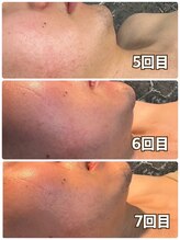 メンズ シンバ(SIMBA)/☆ ビフォーアフター ☆