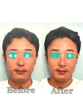 ラグラン銀座メディカルエステ 高輪ゲートウェイ店/男性/小顔+リフトアップ+毛穴