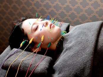 ぱるの写真/初心者の方にも◎プロによる美容鍼で［小顔×肌質改善］にも◎美容鍼×ＥＭＳ＆ラジオ波との組み合わせも◎