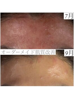 レイ(Rey)/オーダーメイド肌質改善へ