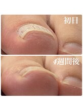 ピーラトゥ 日立(P-Ratu)/巻き爪矯正