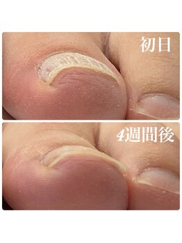 ピーラトゥ 日立(P-Ratu)/巻き爪矯正