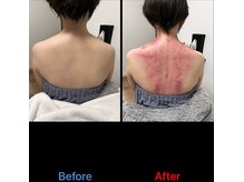 シュガーリングハウスレディ(SugaringHouse LADY)/肩凝り解消