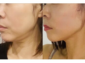 れふぇるん 足利店/二重アゴ&たるみ改善 施術3回