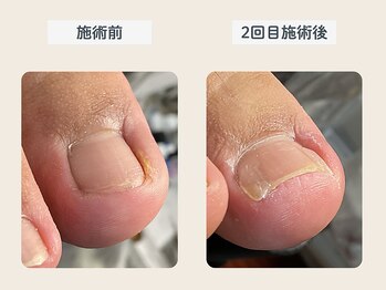 ルポ 伊勢/陥入爪ケア