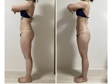 カリス/半身5回☆1ヶ月～2ヶ月に1回施術