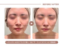 イエス マイサロン(yes My Salon)/レモンボトル施術例