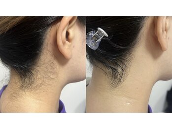 リュール(Lueur)の写真/自分では難しいお手入れもプロにお任せ！Lueurでツルスベ美肌を手に入れよう☆うなじのデザイン相談も◎