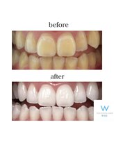 ホワイトニングショップ 町田店/【ビフォーアフター】7回