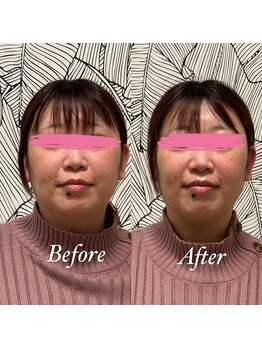 ホルバール 佐賀店(Hallbar)/小顔リフトアップマシーン