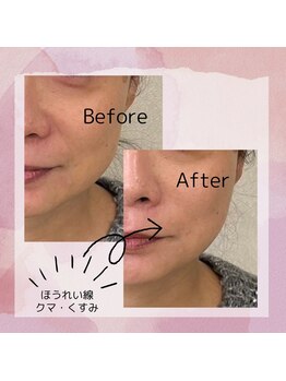 CPヴィアン 本店/ほうれい線、くま、くすみ改善!