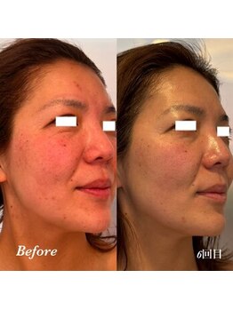 ティアラ(TIARA)/【シミ、美白、毛穴】ピーリング