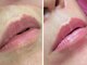 ルアナ(Luana)の写真/《話題沸騰★ローマピンク正規取扱》唇やバストトップ、VIOの黒ずみ&色素を除去！本来のピンク色に♪
