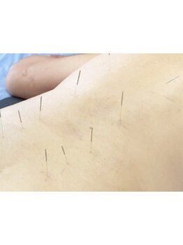 鍼灸施術を受けたい