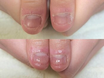 グラシナ なんば店/深爪/自爪育成/フィルイン