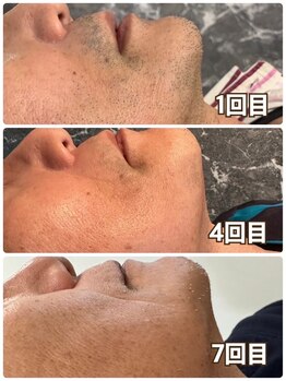 メンズ シンバ(SIMBA)/☆ ビフォーアフター ☆