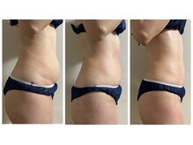 ウィッシュプロサロンケー(Wishpro salon K)の雰囲気（ インディバ2回の変化！左より施術前→1回目→2回目施術後）