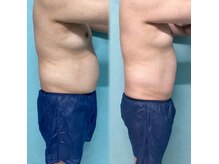 【APTS】 EMS×骨盤矯正×加圧３つのマシンで一気に脂肪を燃焼！