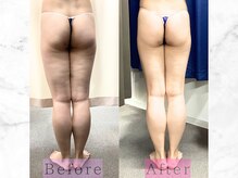 パラディ(PARADIS)/ハイパーナイフ/シェイプ/コルギ