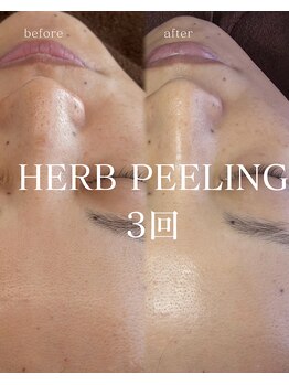 カレン(calin)/ハーブピーリング