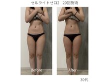 アンベリル(Embellir)/痩身ビフォーアフター