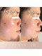 ステラティエ(Stellatier)の写真/目の下のたるみ・ほうれい線にさよなら!輪郭くっきりフェイスライン爆誕へ◎