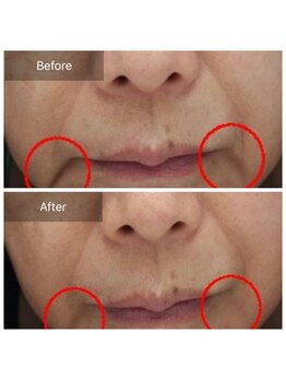 ファヴォリ(favori)/エイジング美肌美容液導入