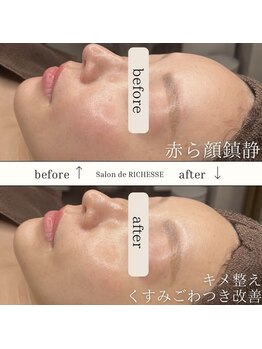サロンドリシェス(Salon de RICHESSE)/赤ら顔鎮静