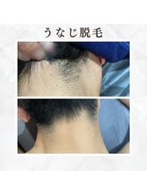 ボゴス(BOGOSS)/【うなじ脱毛】施術写真