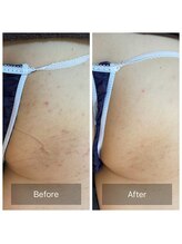 アーユルヴェーダアンドアロマエステ アユス(AYUS)/ハーブピーリング　ヒップ