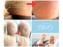 ピーアンドオーつつじ(P&Oつつじ)の雰囲気（角質ケア♪1回で足裏ツルツルに☆硬い胼胝・痛い魚の目除去！！）