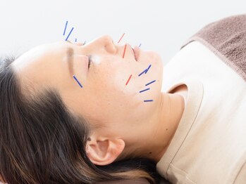 けいのき鍼灸整骨院の写真/繰り返す肌悩みに美容鍼！血流UPでニキビ・毛穴をケアし潤う素肌美肌へ♪