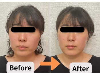 ブプラ 池田店(BUPURA)/小顔 ニキビ フェイスライン