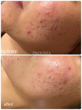 プラウディア(PROUDIA)/化粧品かぶれ/肌悩み/ニキビケア