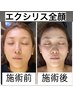 【引き締め・たるみケア】　痩身エクシリス/全顔60分　￥12,000