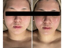 クレビア(CRE'BIA)/小顔フェイシャル